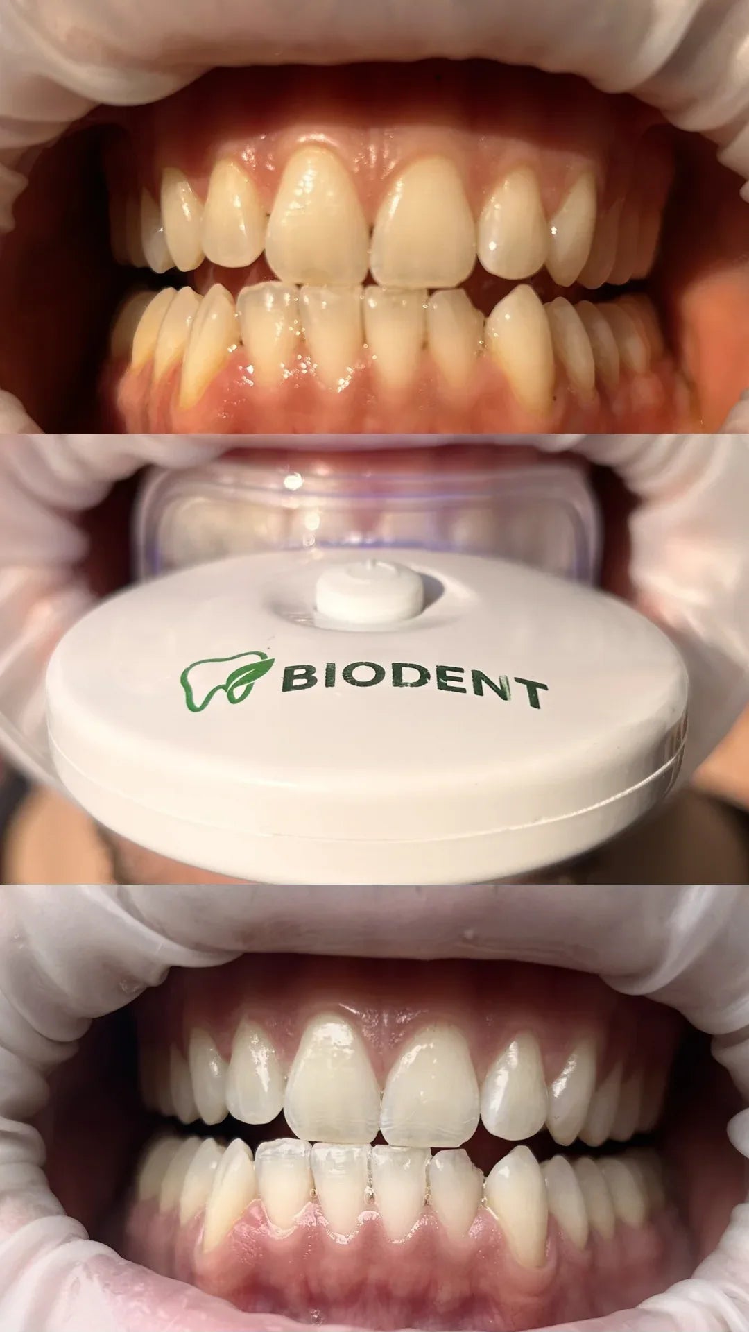 Kit Sbiancante Denti Professionale con lampada LED