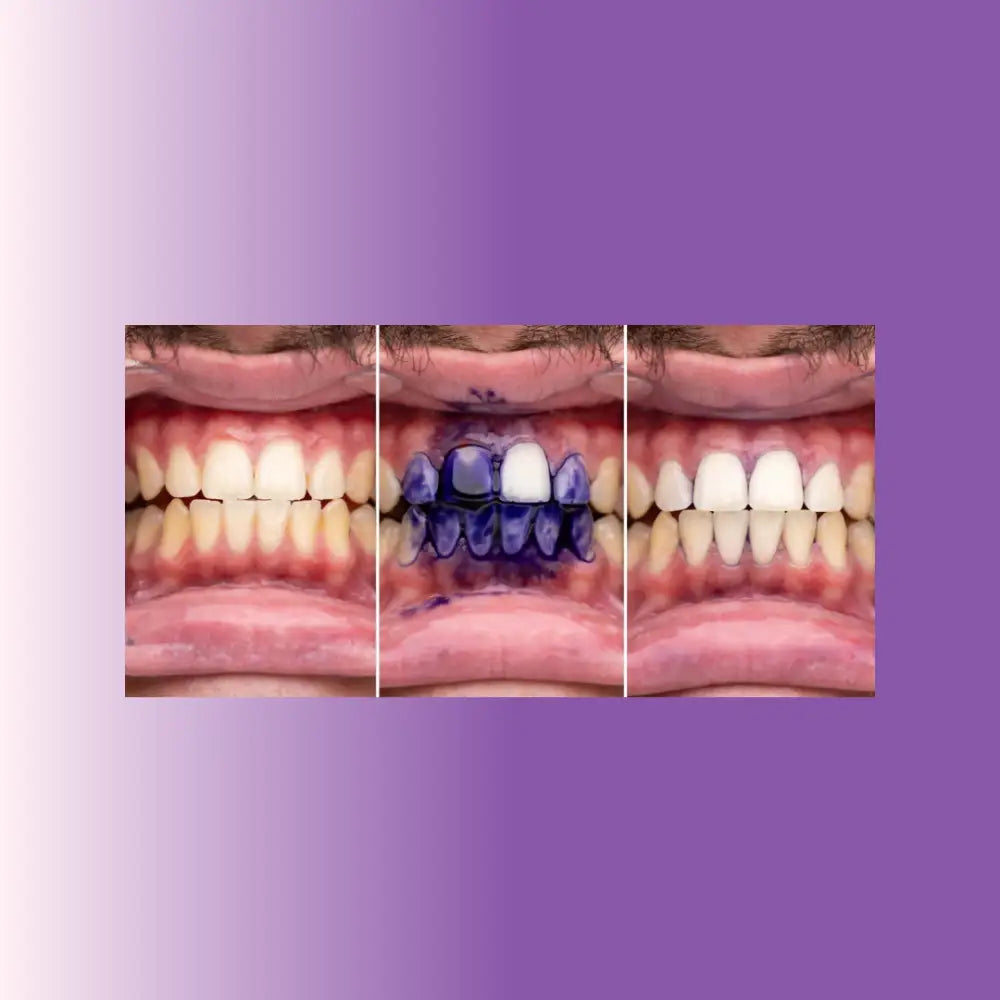 Kit Viola: Siero Viola+ Strisce Viola